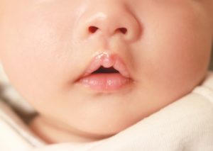 乳幼児に多い お口 の病気 弁理士パパと技術者ママの共働き子育てブログ